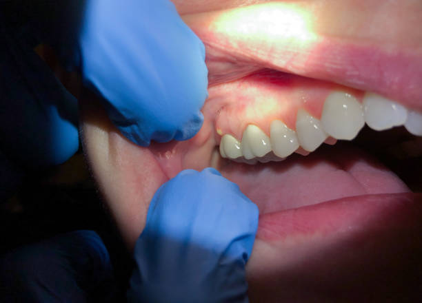 Best Knocked-Out Tooth (Avulsed Tooth) Treatment in Clinton, WA